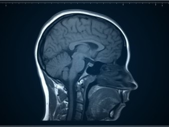 علاج سرطان الدماغ الخبيث