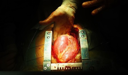 عملية القلب المفتوح