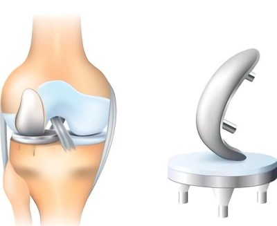 عملية تغيير مفصل الركبة نسبة نجاحها وتجنب المضاعفات