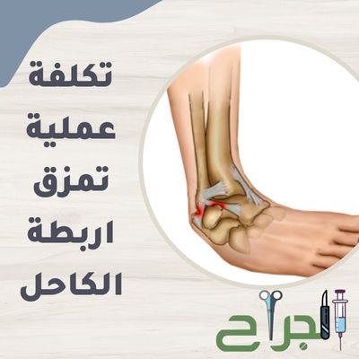 تكلفة عملية تمزق اربطة الكاحل