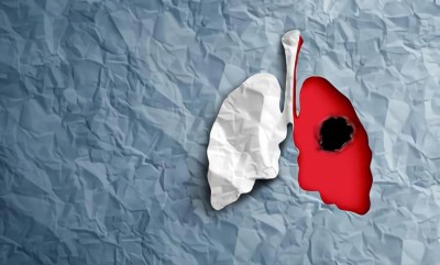 مضاعفات عملية استئصال الرئة