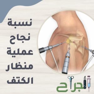 نسبة نجاح عملية منظار الكتف