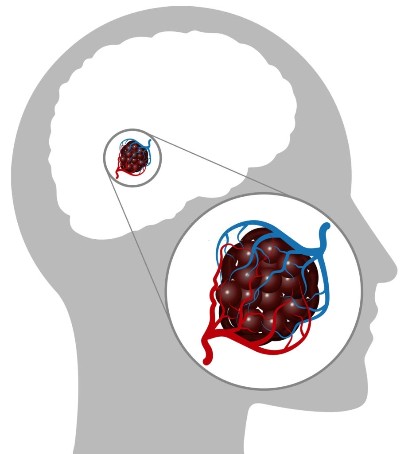 الورم الوعائي في الدماغ