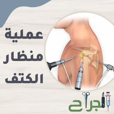 عملية منظار الكتف 2025 واهم المعلومات عنها